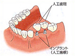 インプラント