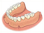 入れ歯（保険適用の場合）